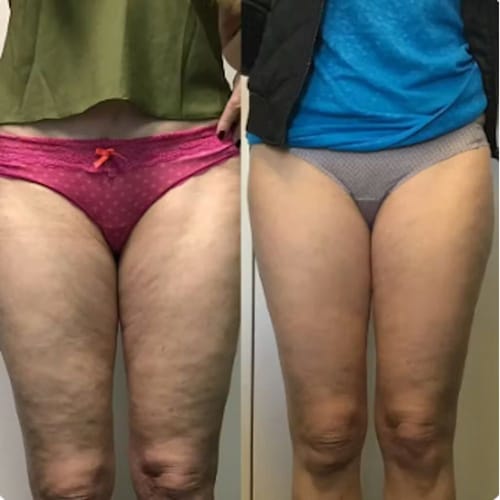 Customer photo - Vivien J., thighs before and after
